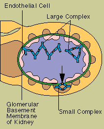 Disorders of the Immune System: Immune Complex Disease
